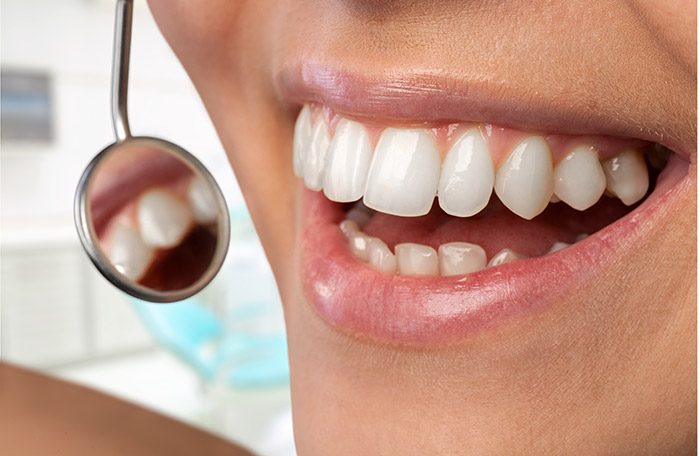 דרכים שונות לביצוע הלבנת שיניים