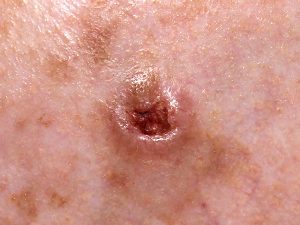 כל מה שצריך וחשוב לדעת על סרטן העור