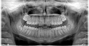 טיפולי שיניים בהרדמה מלאה- מה צריך לדעת