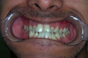 שיטות לביצוע יישור שיניים