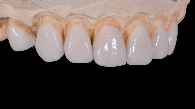 באילו מקרים מבצעים השתלות שיניים?